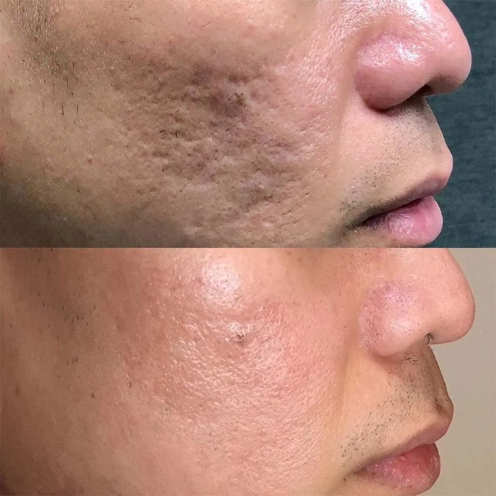 Comparação de antes e depois da bochecha: manchas e textura irregular na foto de cima, pele mais uniforme embaixo.