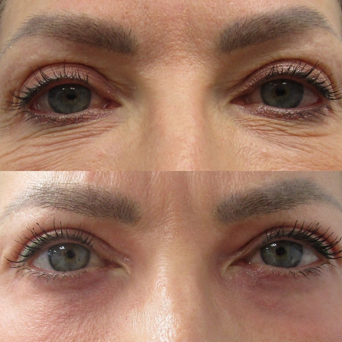 Comparação de antes e depois da região dos olhos, com linhas da pálpebra mais visíveis na foto de cima.