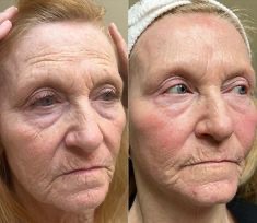Comparação lado a lado do rosto, com foco nas pálpebras.