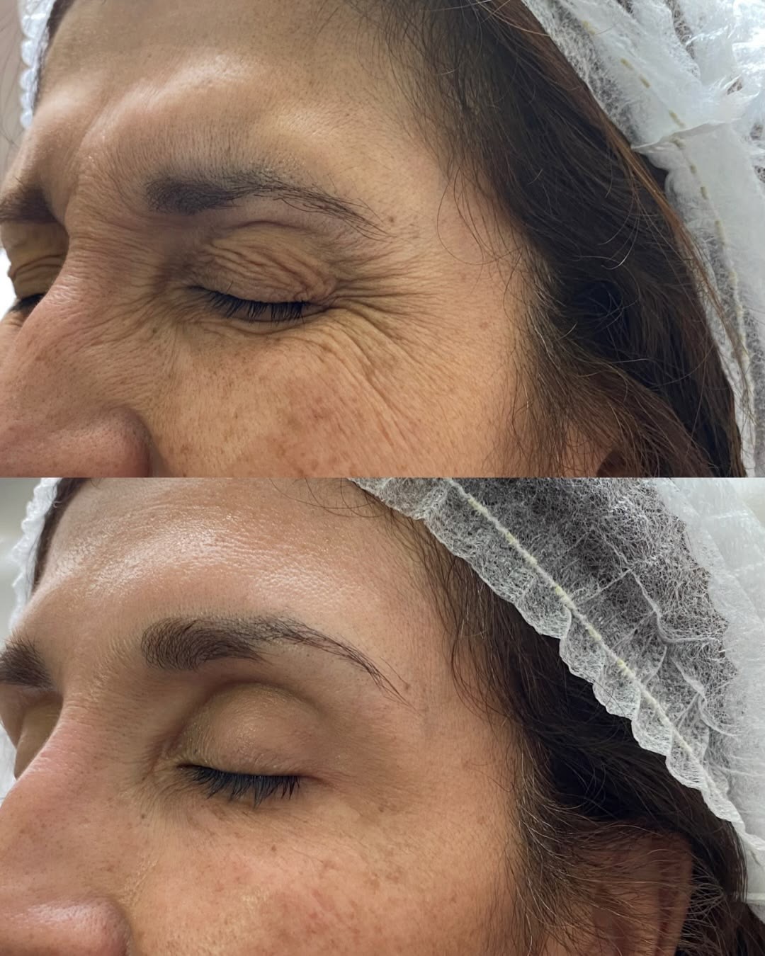 Comparação de antes e depois da testa e da pálpebra, com linhas mais marcadas na foto de cima.